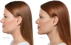Kybella Before and After