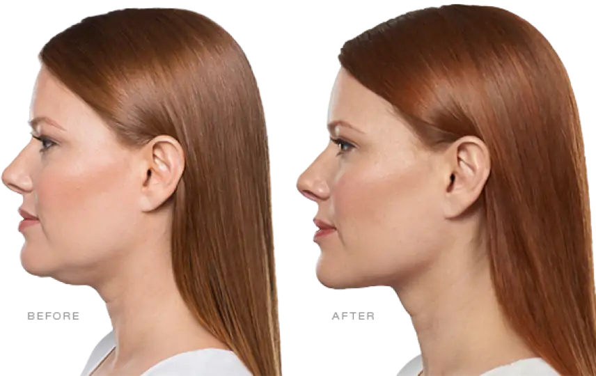Kybella Before and After