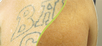 5 Aftercare Tips for Laser Tattoo Removal