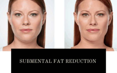 Submental Fat Reduction