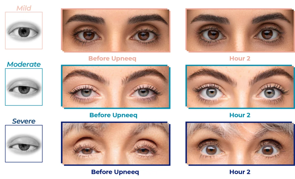 Upneeq (Oxymetazoline) – Non-Surgical Drooping Eye Treatment