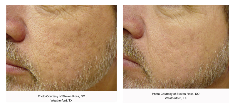 before and after laser genesis