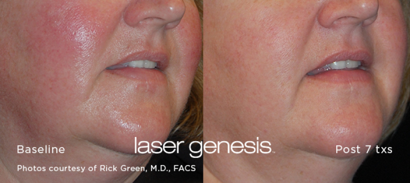 before and after laser genesis