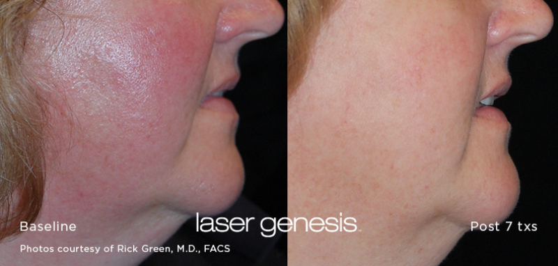 before and after laser genesis