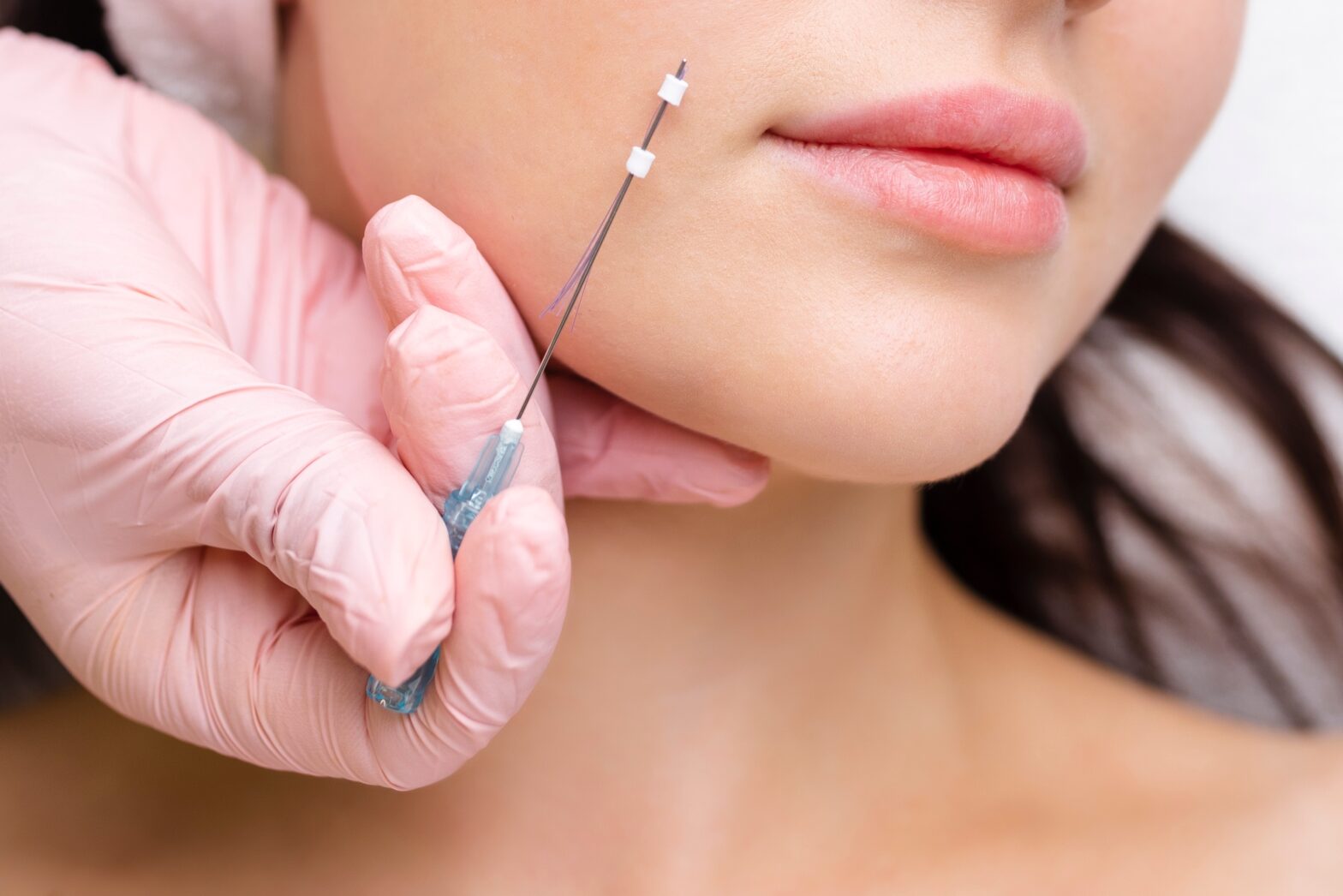 Woman getting a thread lift procedure done.