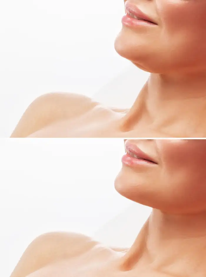 Double Chin Before & After