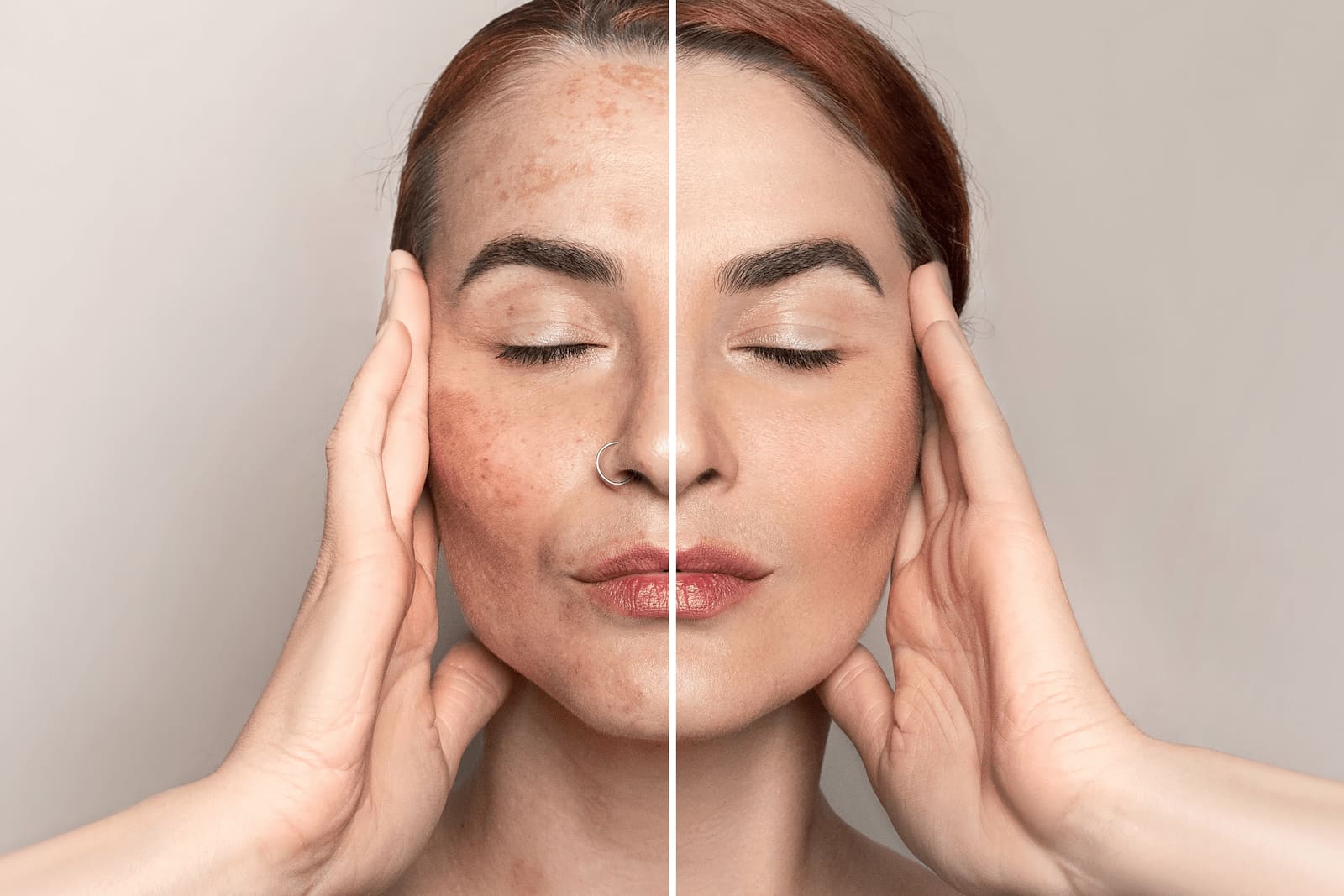 How to Treat Melasma and Pigmentation in Kansas City: What Actually Works?